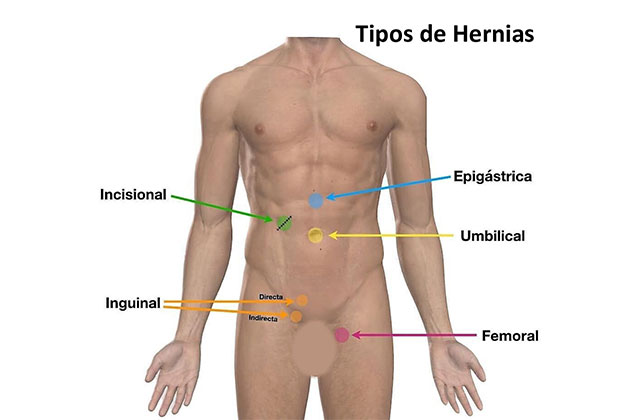 Cirugía Hernia Pared Abdominal Dr. Javier Díaz A.