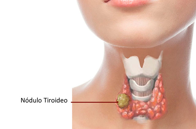 Cirugía tiroides Dr. Javier Díaz A.